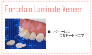 ポーセレンラミネートべニア