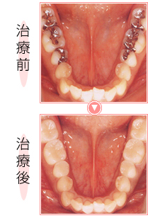 スマイルエステ・術前